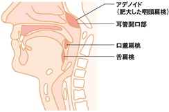 アデノイド肥大 | のどの病気 | 株式会社龍角散